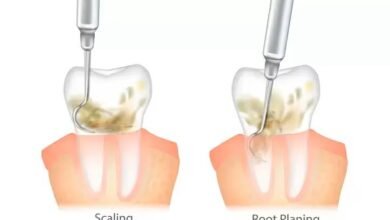 deep cleaning and root planing