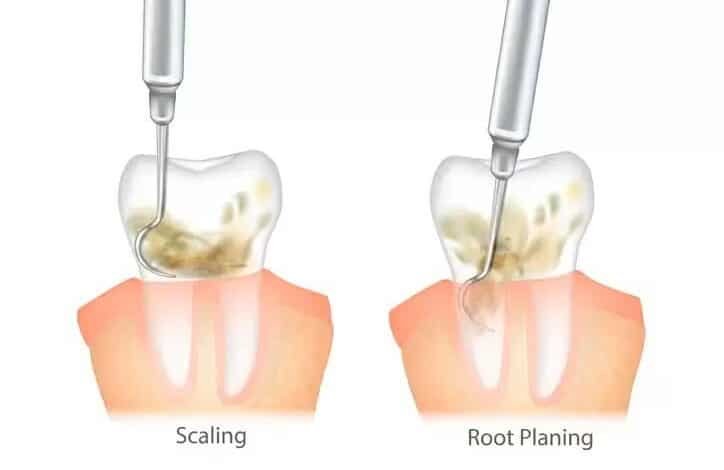 deep cleaning and root planing